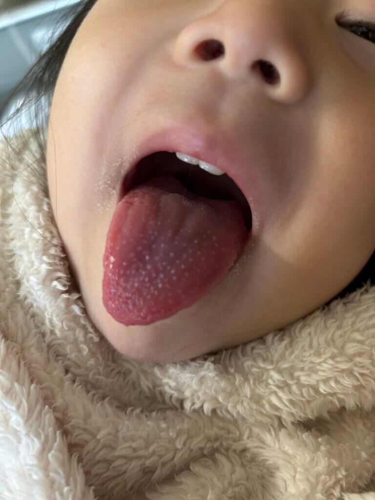 舌にぶつぶつ